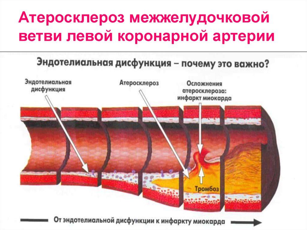 Лечение атеросклероза артерии. Атеросклероз коронарных сосудов. Осложнения атеросклероза коронарных артерий. Атеросклероз эндотелиальная дисфункция. Рецепторы коронарных сосудов.