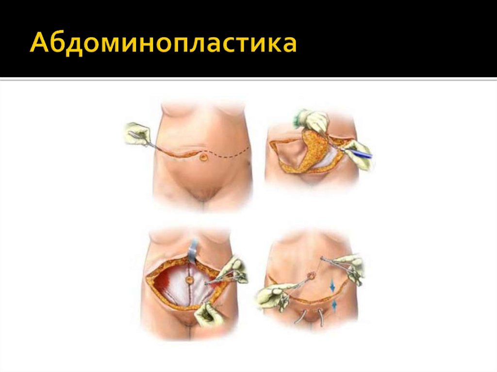 Абдоминопластика