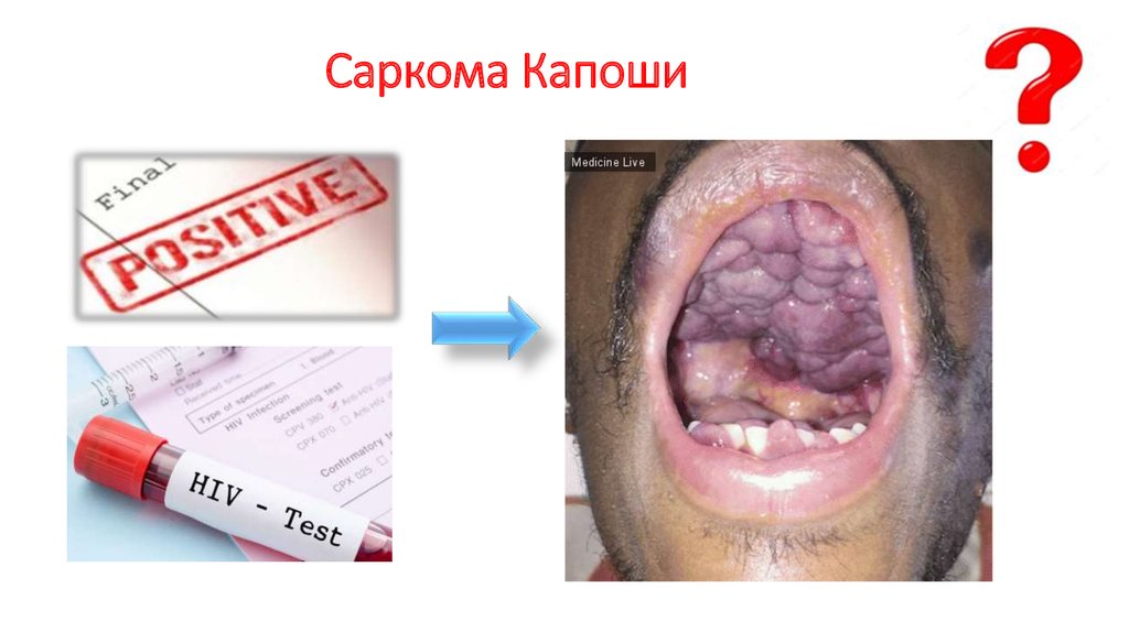 Саркома Капоши