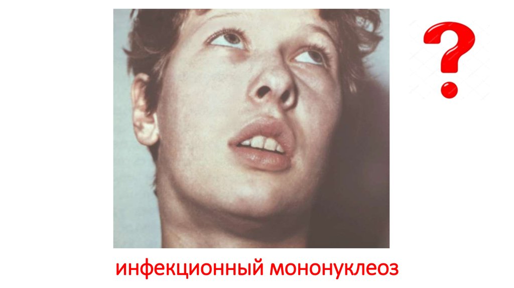 инфекционный мононуклеоз