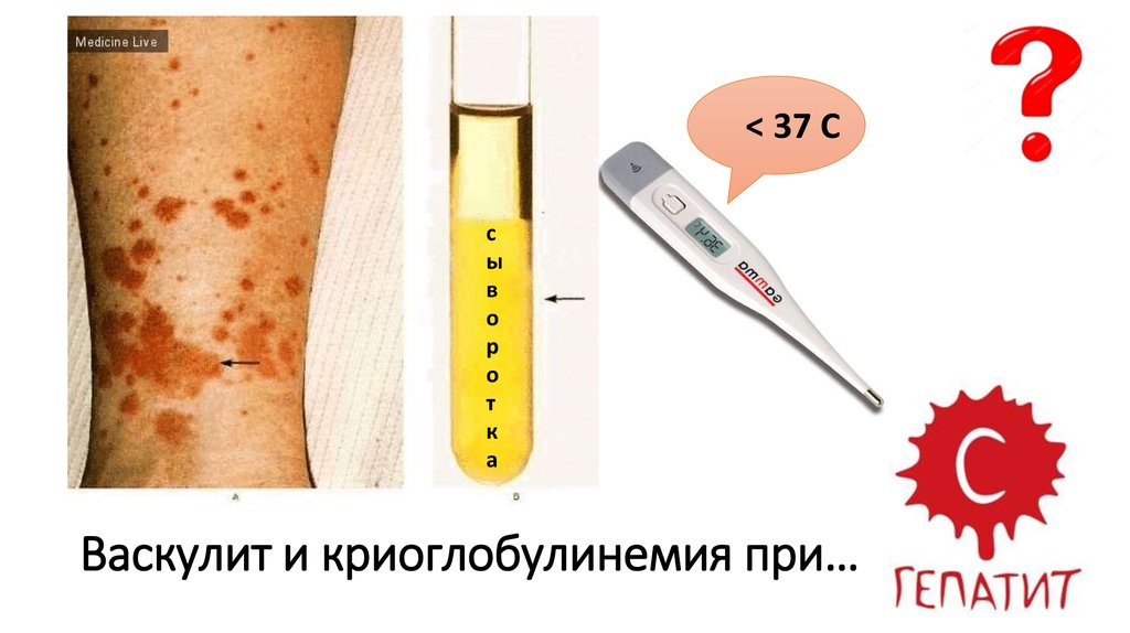 Васкулит и криоглобулинемия при…