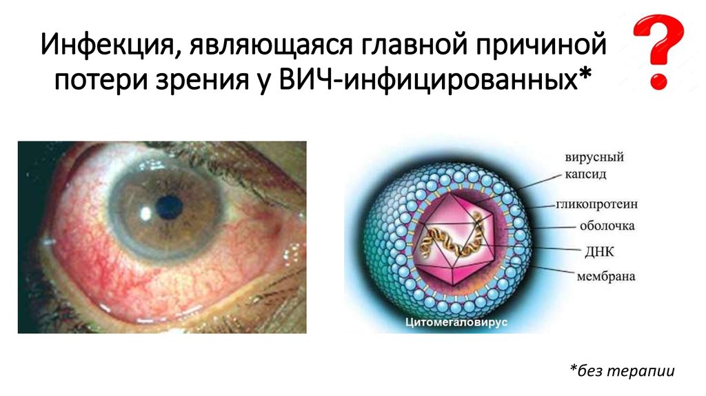 Инфекция, являющаяся главной причиной потери зрения у ВИЧ-инфицированных*