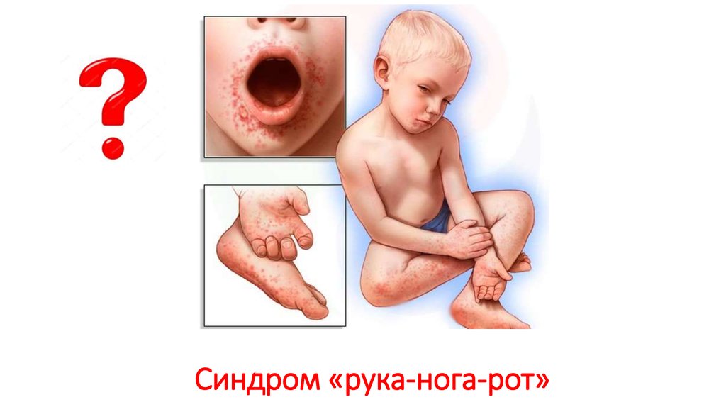 Синдром «рука-нога-рот»