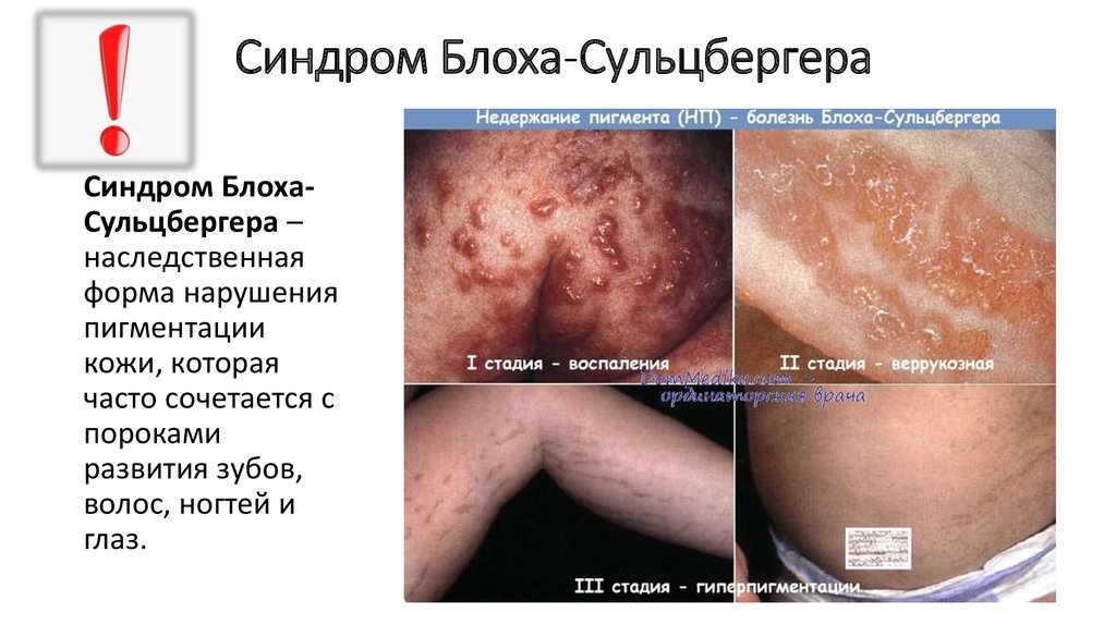 Синдром Блоха-Сульцбергера