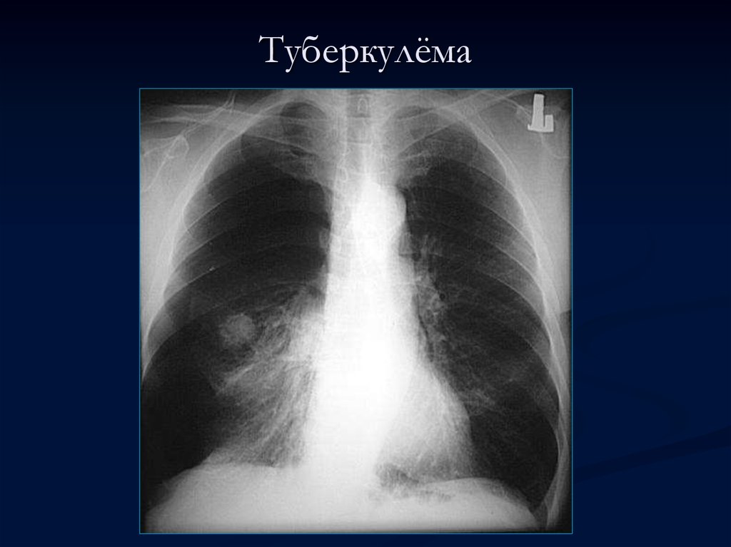 Туберкулез легкого рентгенограмма