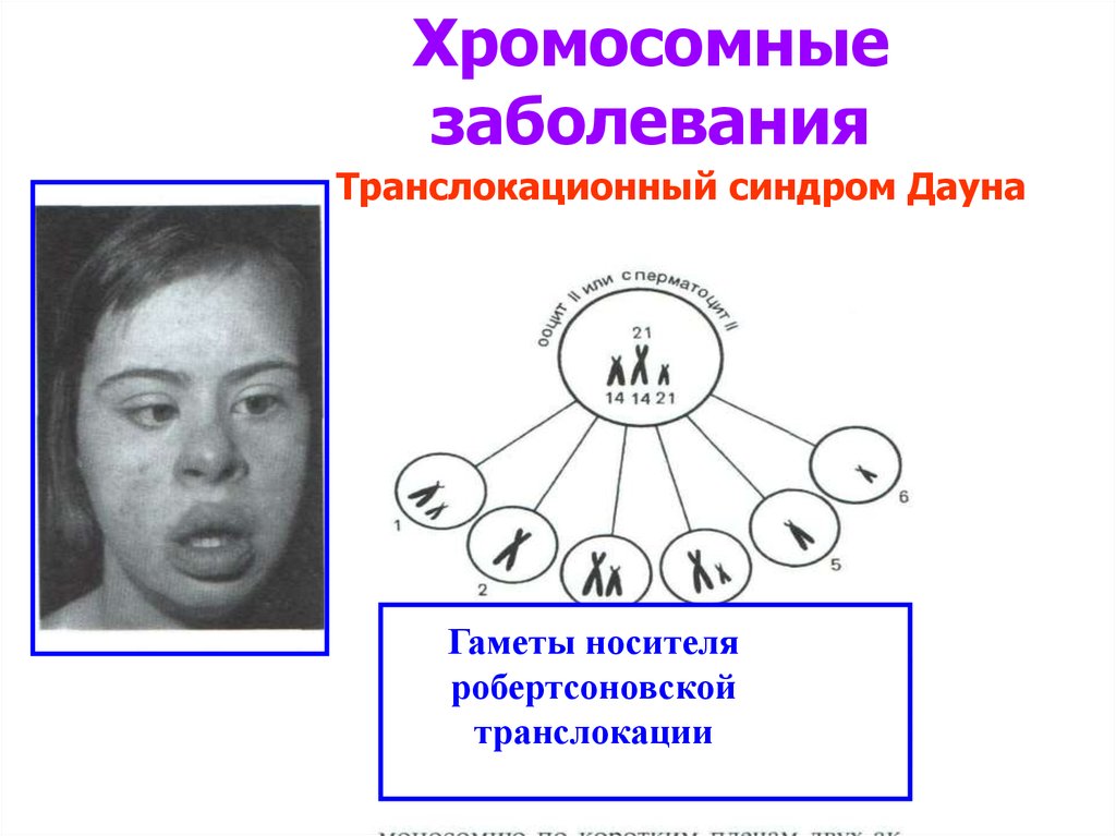 Хромосомные заболевания дауна. Робертсоновская транслокация синдом Дауна. Хромосомные заболевания. Хромосомные болезни транслокации. Хромосомные заболевания синдром Дауна.