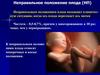 Неправильное положение плода (НП)