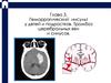 Геморрагический инсульт у детей и подростков. Тромбоз церебральных вен и синусов