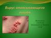 Вирус опоясывающего лишая