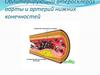 Облитерирующий атеросклероз аорты и артерий нижних конечностей
