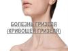 Болезнь Гризеля (кривошея Гризеля)