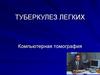 Туберкулез легких. Компьютерная томография