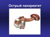 Острый панкреатит