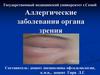 Аллергические заболевания органа зрения