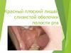 Красный плоский лишай слизистой оболочки полости рта