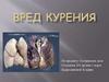 Вред курения