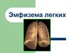 Эмфизема легких