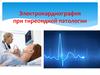 Электрокардиография при тиреоидной патологии