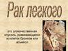Рак лёгкого