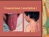 Одна з форм стрептококової інфекції скарлатина