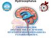 Гидроцефалии. Диагностика и лечение. Шунтирующие операции на головном мозге