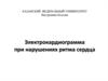 Электрокардиограмма при нарушениях ритма сердца